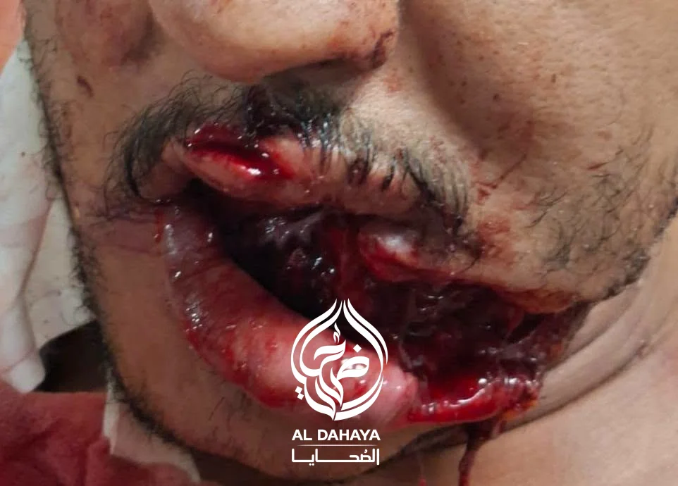 صورة 3 - بين الحياة والموت.. أطباء سوهاج الجامعي ينقذون شابًا بعد إصابة مروعة بالوجه والفك