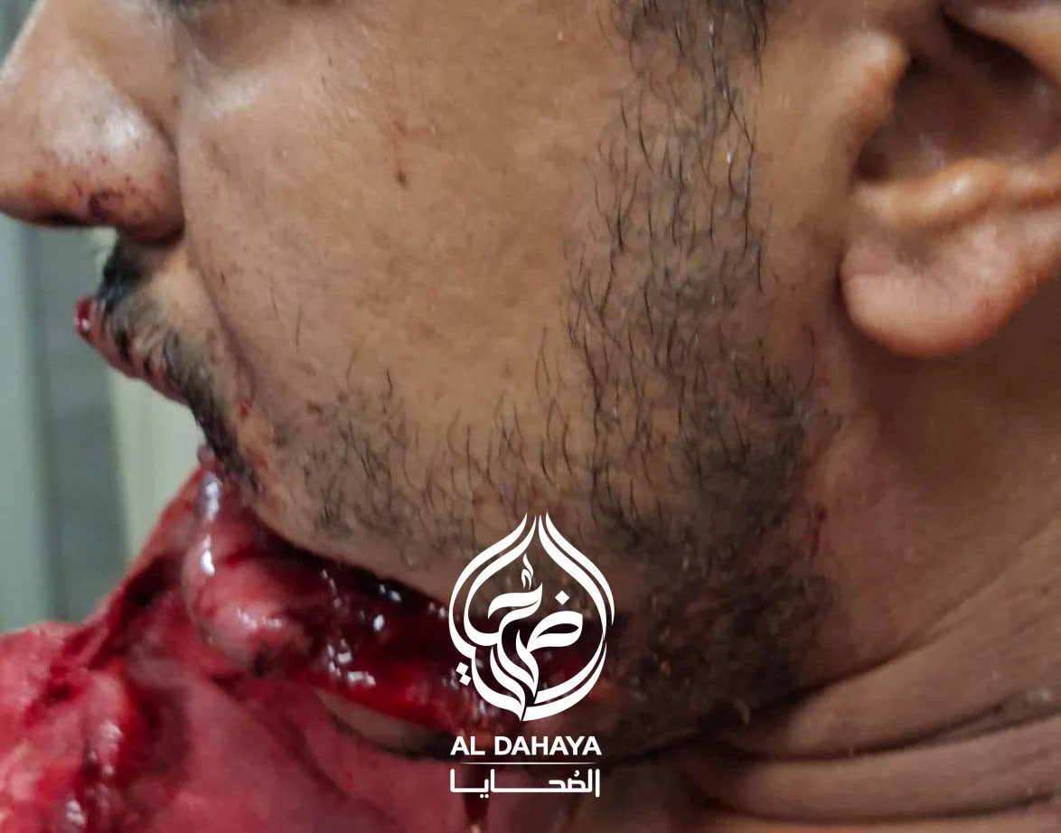 صورة 4 - بين الحياة والموت.. أطباء سوهاج الجامعي ينقذون شابًا بعد إصابة مروعة بالوجه والفك