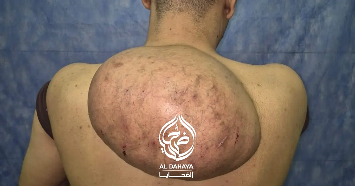 بالصور : مستشفيات سوهاج الجامعية تنجح في استئصال ورم دهني ضخم يزن 15 كيلوجرامًا من ظهر مريض
