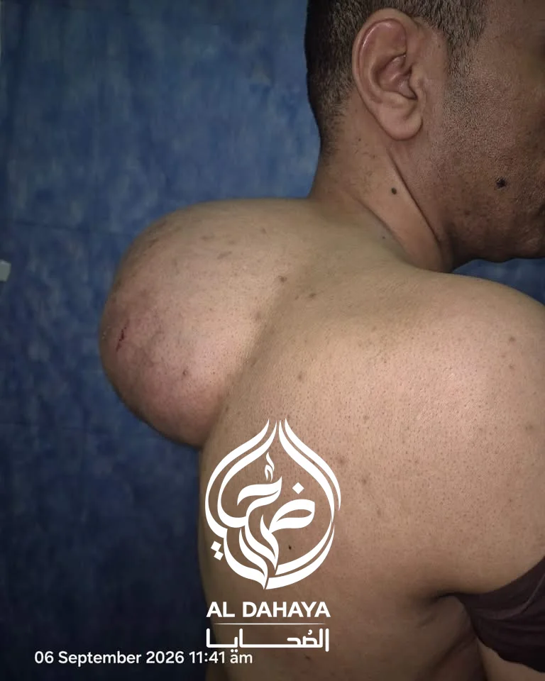 صورة 1 - بالصور : مستشفيات سوهاج الجامعية تنجح في استئصال ورم دهني ضخم يزن 15 كيلوجرامًا من ظهر مريض