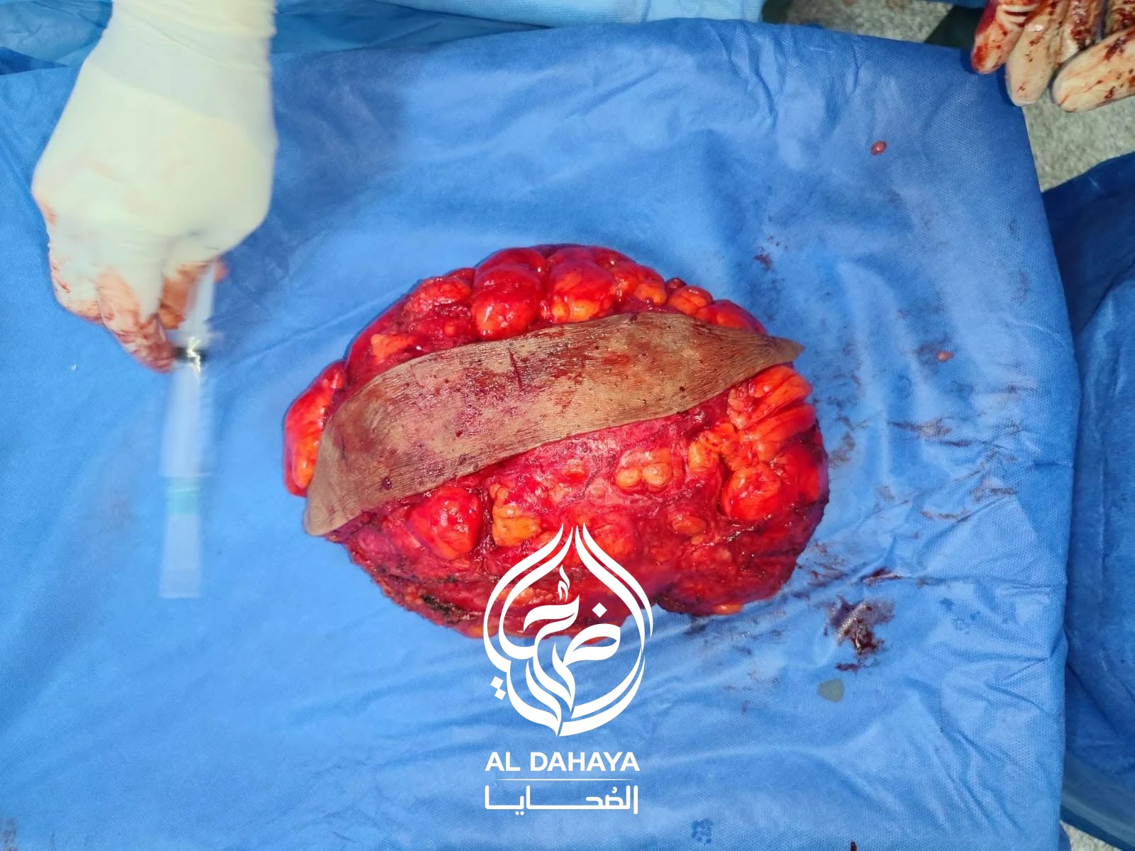 صورة 2 - بالصور : مستشفيات سوهاج الجامعية تنجح في استئصال ورم دهني ضخم يزن 15 كيلوجرامًا من ظهر مريض